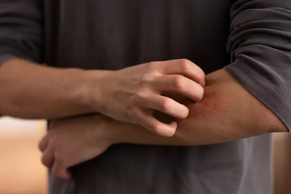 Person Suffering Hives Arm Skin